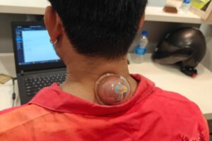Cupping